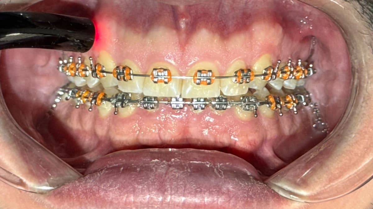 Ortodoncia asistida con láser en Buenos Aires