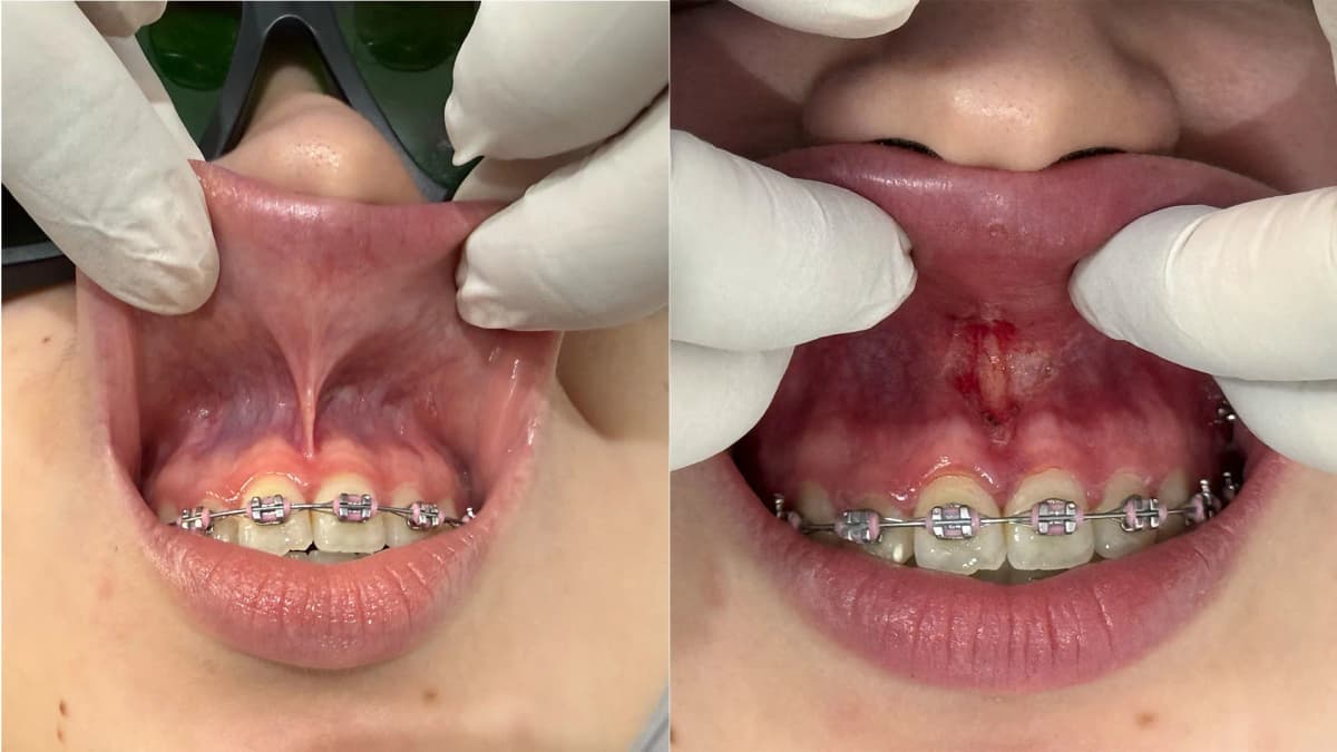 Frenectomía con láser: técnica sin suturas ni dolor